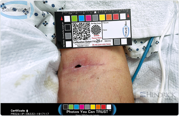 Wound Image 1