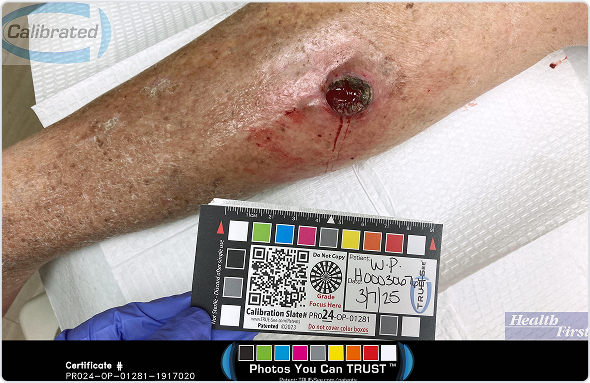 Wound Image 2